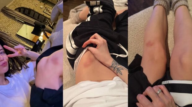 Синці Наді Дорофєєвої, кадри з відео