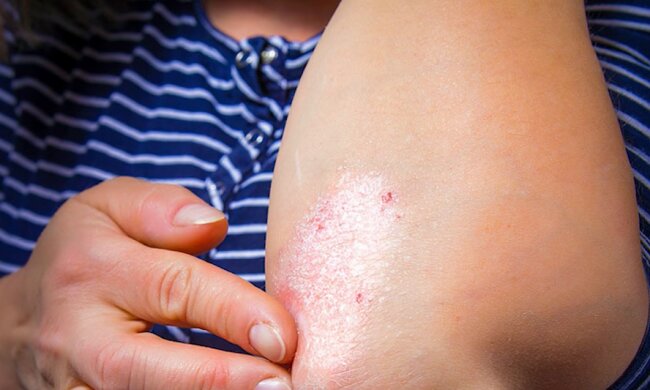 Просто і ефективно. Лікарі розповіли, споживання яких продуктів лікує псоріаз