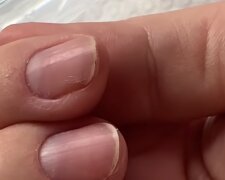 Перевірте свої нігті на руках: прості симптоми, які розкажуть про прихований рак