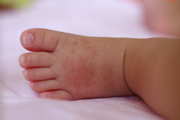 Есть в повседневном рационе каждого: врачи назвали самую опасную пищевую аллергию у детей